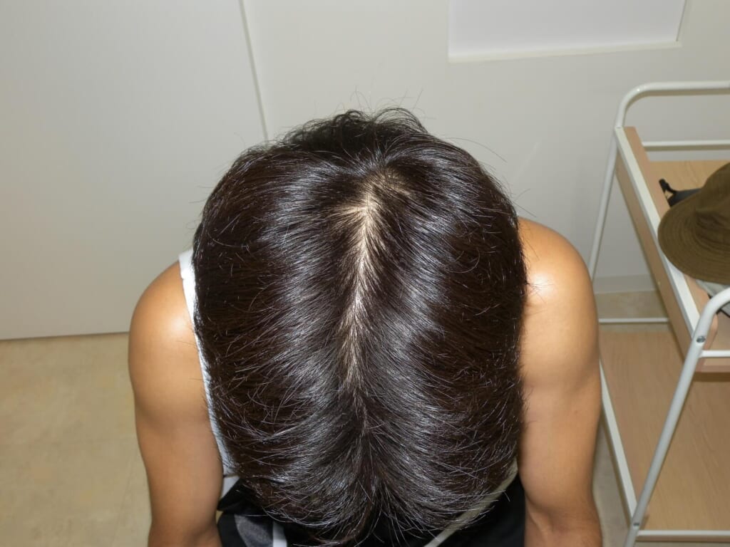 Oops Hairの治療実例画像