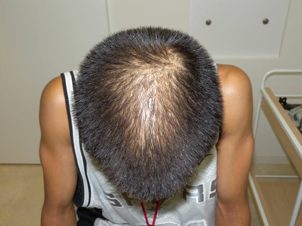 Oops Hairの治療実例画像
