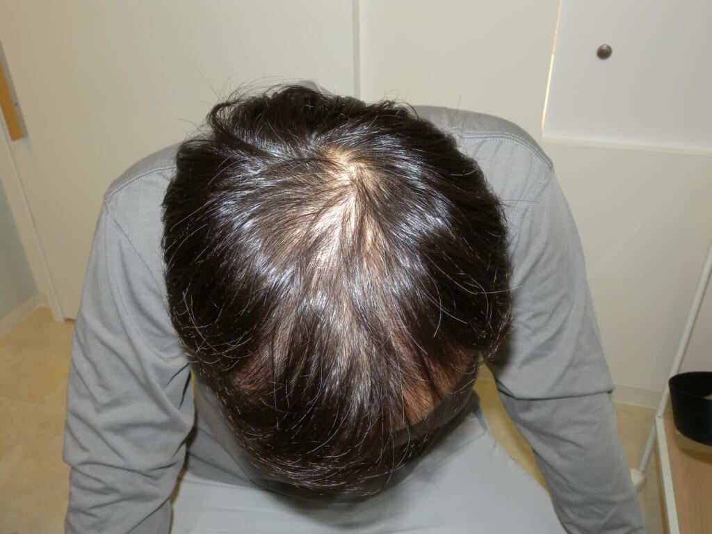 Oops Hairの治療実例画像