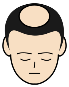 AGA進行中期 3段階目の頭皮のイラスト